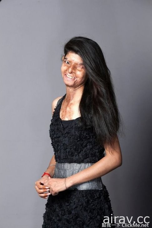 印度女孩血淋淋的写真：“ 硫酸毁了我的容貌，但毁不了我的坚强。”