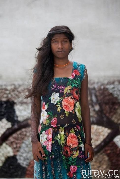 印度女孩血淋淋的写真：“ 硫酸毁了我的容貌，但毁不了我的坚强。”